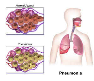 Pneumonia Classification, Causes, Pathophysiology, Management and Prevention
