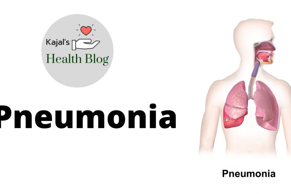 Pneumonia| Classification, Causes, Prevention and Management